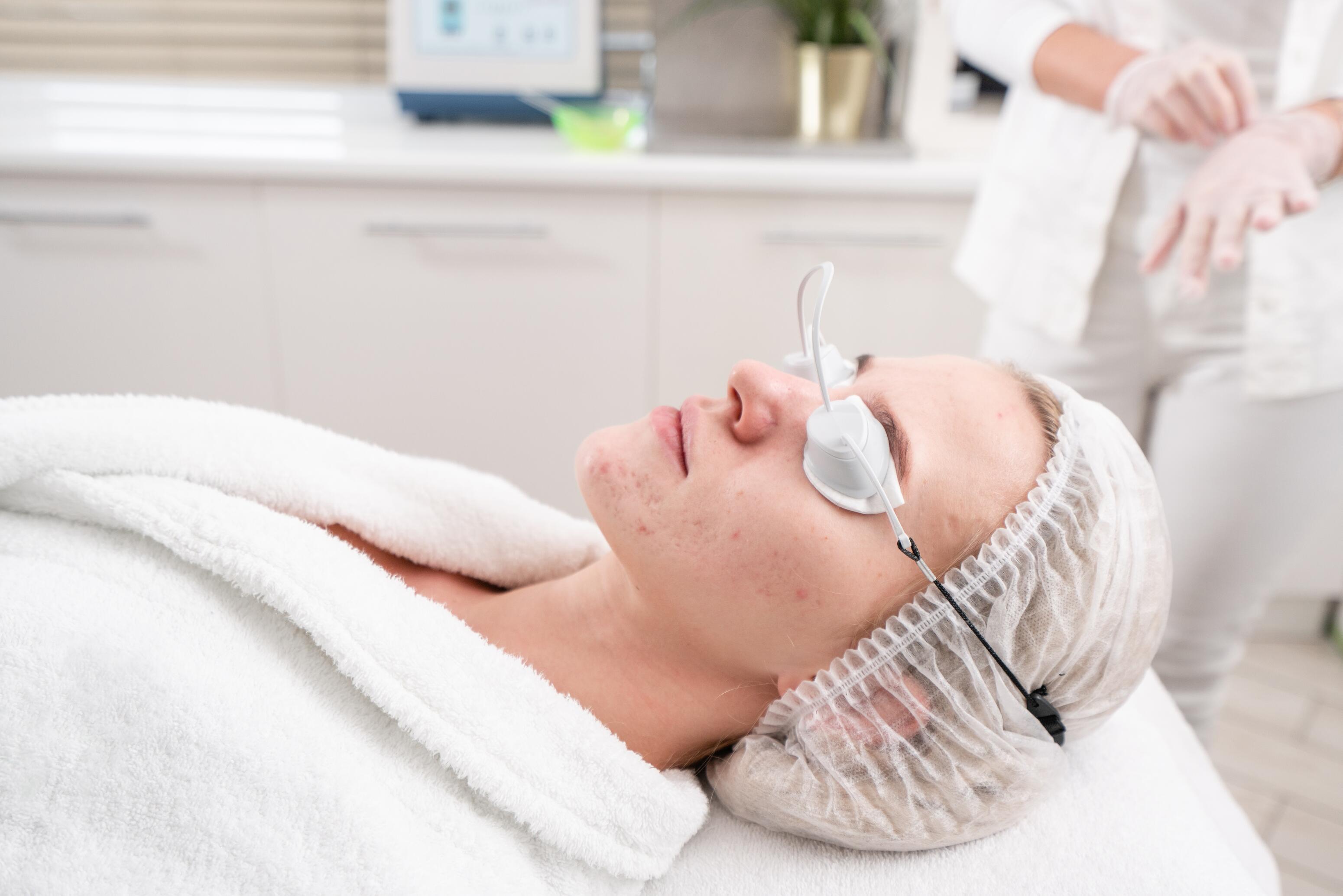 Laser treatment for acne scars